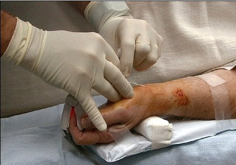 Arterial catheter procedure