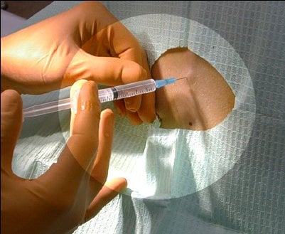 Local anaesthetic injection