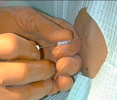 Spinal needle insertion