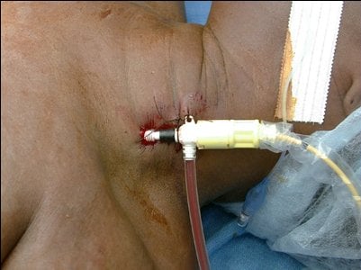Central venous catheter