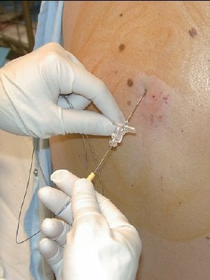 Epidural procedure